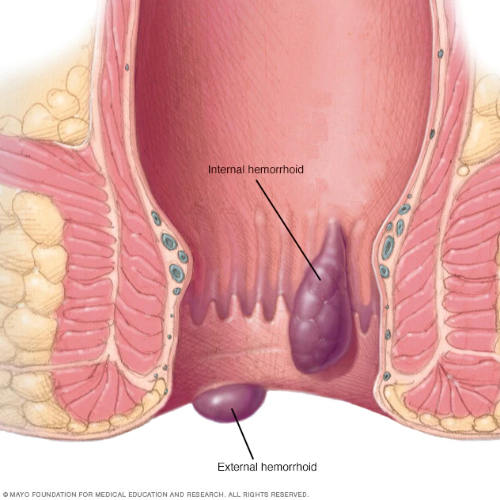 Proctology Hemorrhoids Piles Fissure and Fistula